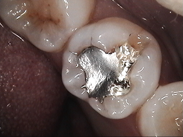 銀歯の二次虫歯をレジン（保険治療）で修復 | 治療症例集